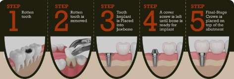 dental implants