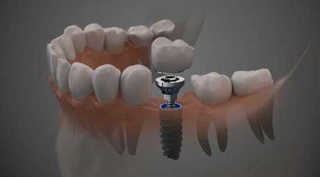 dental implants